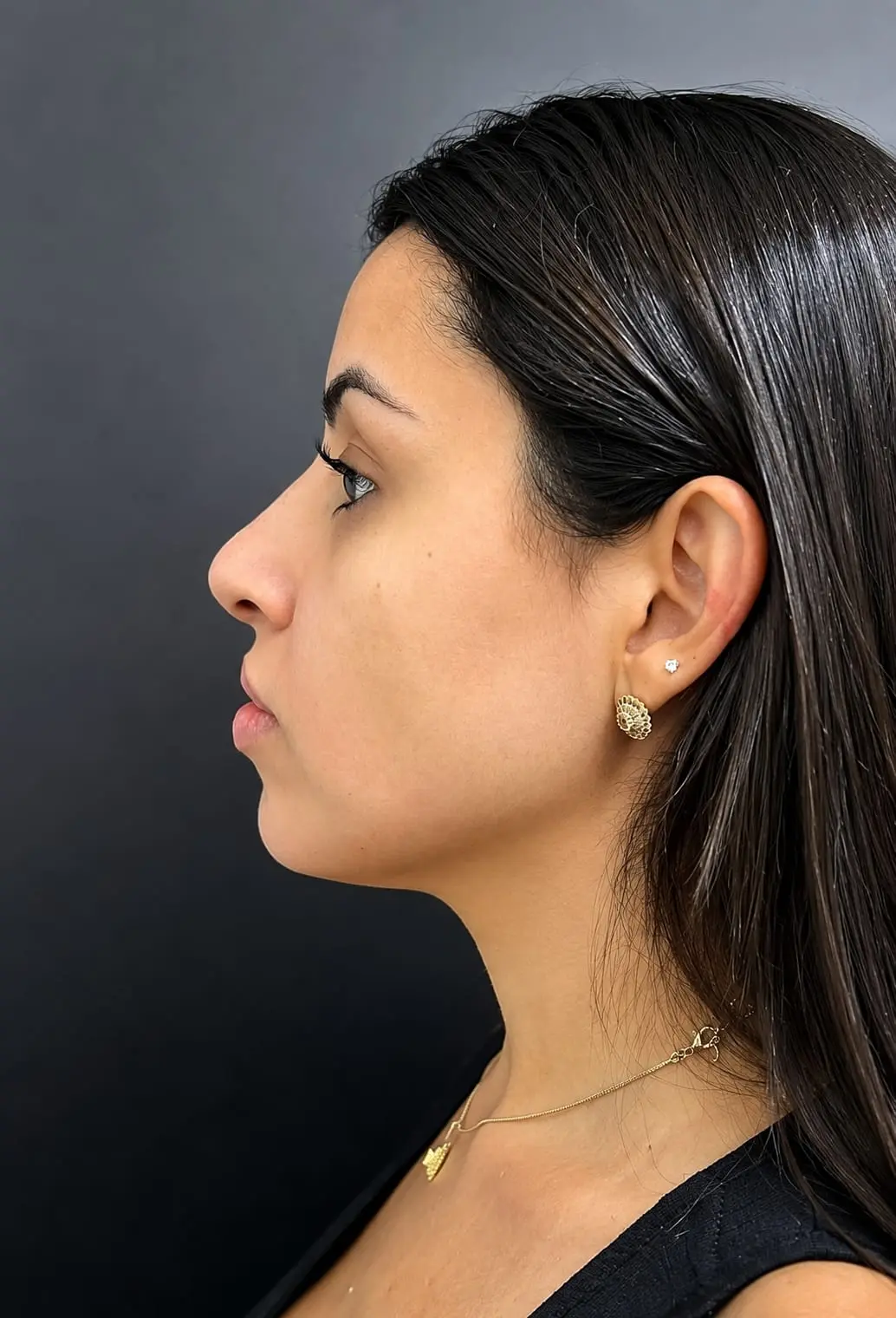 Preenchimento Facial em Santana, São Paulo